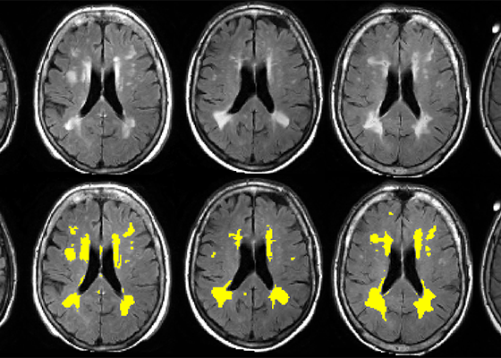 International Study Examines Genetic &amp; Vascular Risk Factors for Brain Infarcts