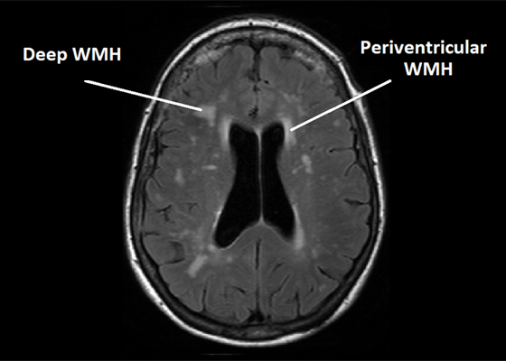 Genome-Wide Association Study Identifies Genetic Variants for Two Neuroimaging Traits