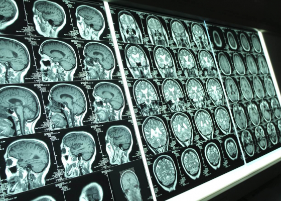 Fully Automated Software to Detect White Matter Lesions